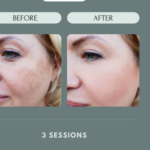 One Cryofacial From The Hair Gallery