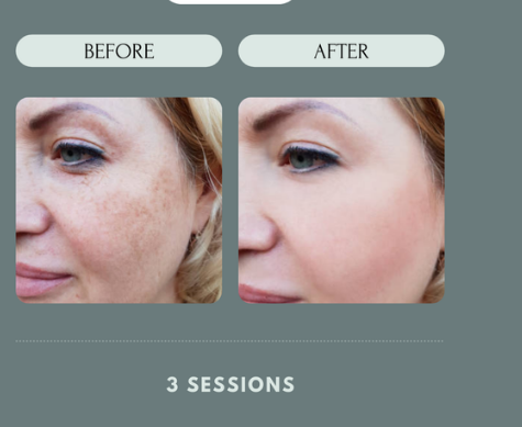 One Cryofacial From The Hair Gallery